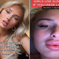 Woman reveals her extreme and painful lip filler swelling